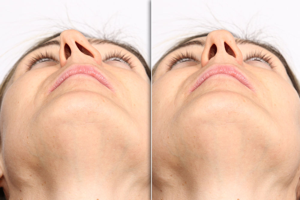 Houston Advanced Nose Sinus Septoplasty Page Image 1