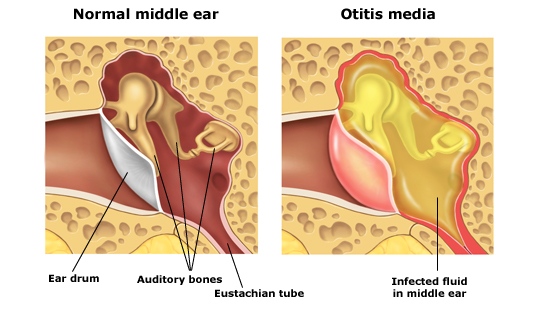 Otitis-Media.jpg