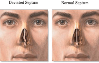 Rhinoplasty For a Deviated Septum