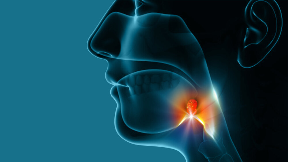 Throat Cancer Signs Symptoms Westside Head Neck