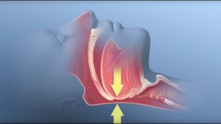 Obstructive Sleep Apnea