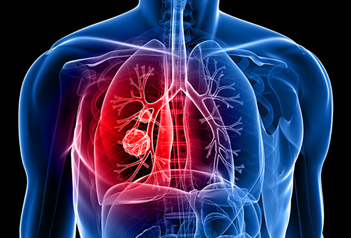 493ss_thinkstock_rf_lung_cancer_illustration.jpg