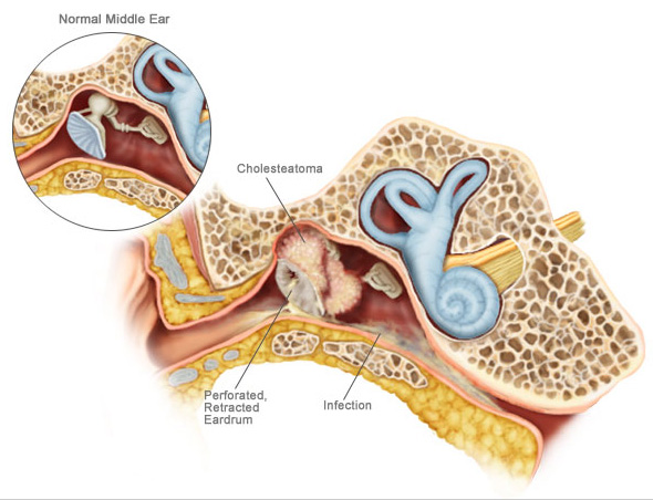 Causes, Symptoms, and Diagnosis for Cholesteatoma