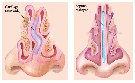 Submucosal Resection of the Nose for Treatment of Deviated Septum