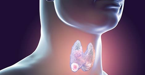 throat-cancer-signs-symptoms-thumb.jpeg