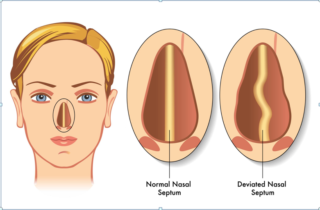 5 Signs of a Deviated Septum