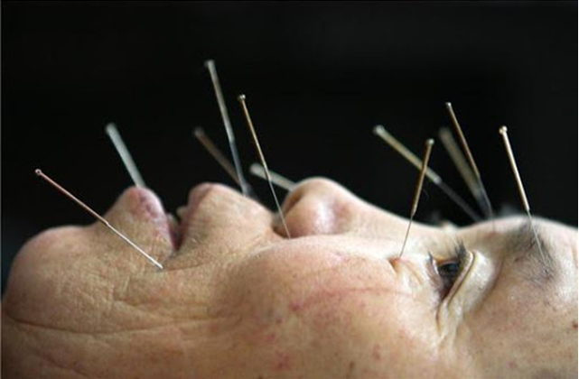 acupuncture.png