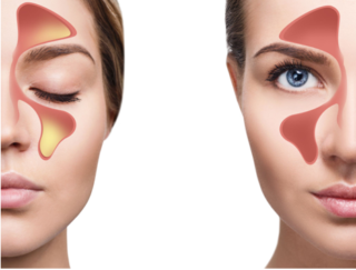 Balloon Sinuplasty for Chronic Sinus Issues