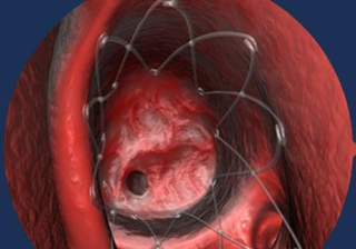 Stents to Treat Chronic Sinus Issues