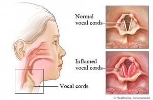 Doctor for Laryngitis Treatment in Los Angeles